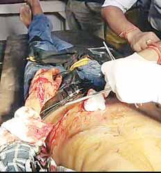 खूंथी में शराब पीने के बाद हंगामा, चाकू चले; दो घायल