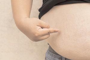 Study shows severe obesity may raise risk of 16 common conditions