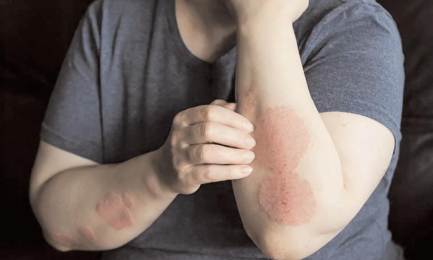 Study shows why psoriasis patients may be at risk of obesity, fatty liver disease