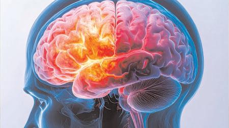 Study finds genetic link for rare childhood brain developmental disorder
