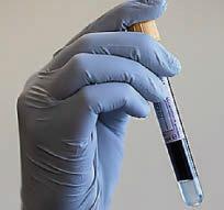 Blood tests pick up 95% of dementia