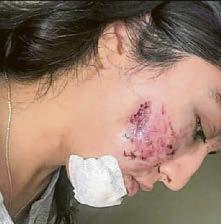 I'm lucky to be alive ..after magpie attack