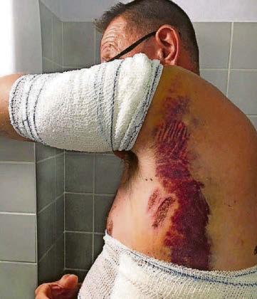 Angler feared he was dead after lightning struck tree beside him