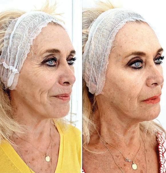 Could a salmon sperm cocktail rejuvenate my 'Ozempic face'?