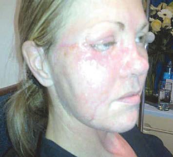 'Antibiotic-resistant infection ate my face after crash'