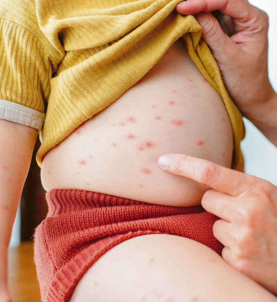 NHS offers chickenpox jabs to protect children