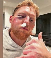 Ben left in right state after ball hits face