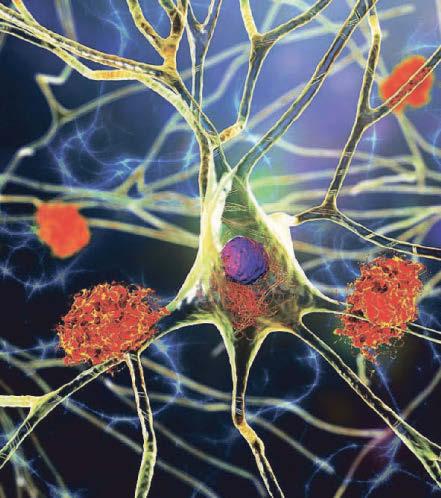 Alzheimer's 'is setting in decades before we spot signs'