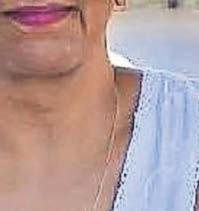 'How pork scratchings left me ill for a year'