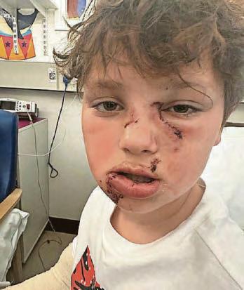 Eight-year-old boy 'recovering well' from surgery after horror dog attack