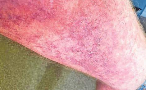 'If my partner so much as moved the duvet, I was screaming in agony'