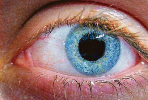 Retired nurse in her 80s 'removed cyst from own eye' after years waiting for treatment