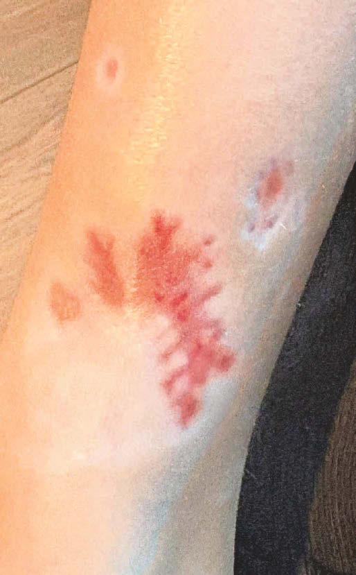 SCARRED GIRL'S MUM SLAMS SENTENCE AFTER 'POCKET BULLY' HORROR