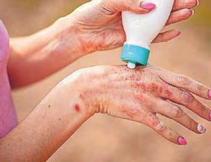 How to spot, treat, and prevent scabies