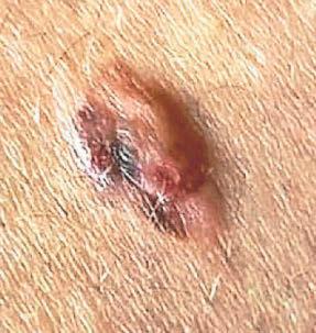 'SKIN CANCER ISN'T JUST A MOLE BEING REMOVED'