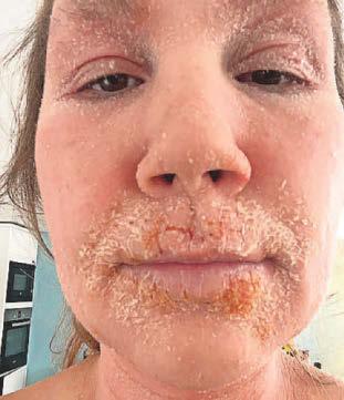 Rash agony Lily raises awareness of steroid withdrawal