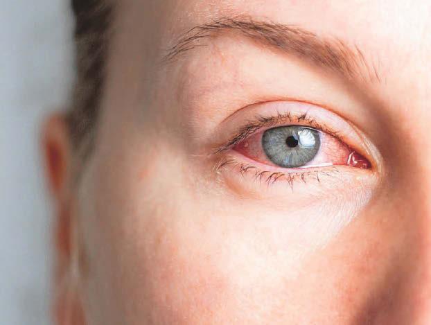 FOCUS ON GLAUCOMA