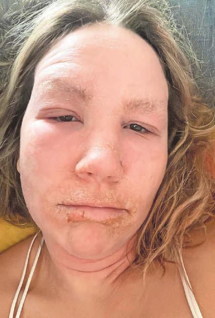 'Decade of using steroid cream left me in agony'