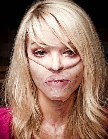 'The kindness of strangers got me through dark days after acid attack'