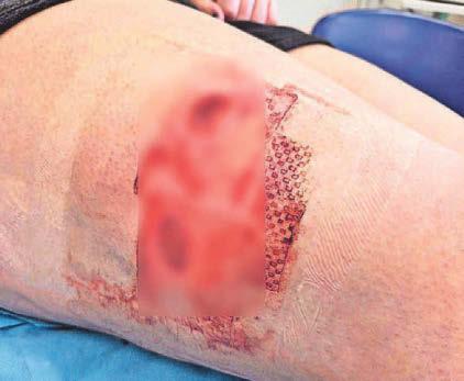 Dog attack in street left my teenage daughter needing surgery