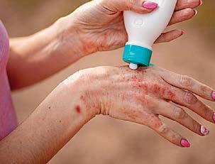 How to spot, treat, and prevent scabies