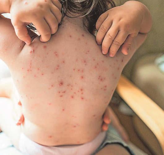 Jab for chickenpox will be offered to children in Wales