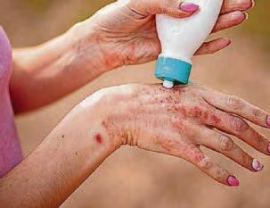 How to spot, treat and prevent scabies