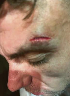 Dad's holiday nightmare as he is beaten up in Turkish hotel