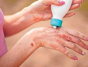 How to spot, treat and prevent scabies