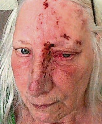 Gran left 'unrecognisable' after nap in the sun