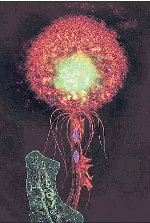 EXHIBITION HOPES TO SHIFT ATTITUDE TOWARDS CANCER