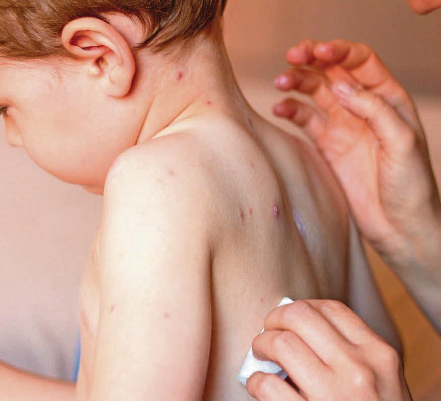 How can we safely soothe our young child's itchy skin?