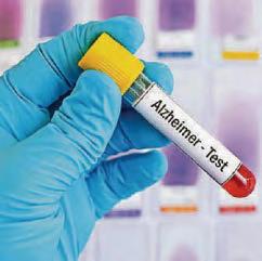 Alzheimer's blood test can measure disease's progress