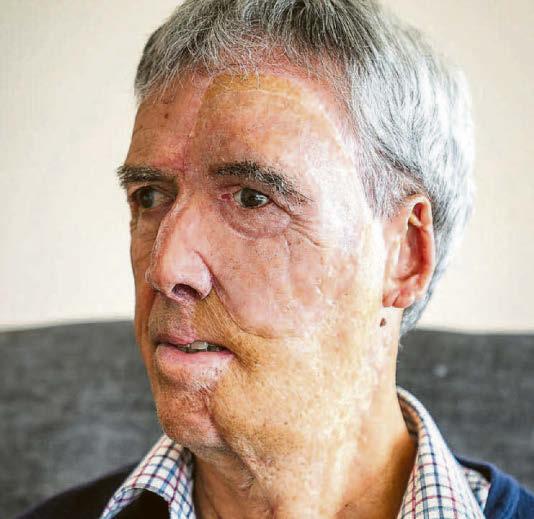 3D-printed face helped cyclist rebuild his life