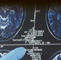 1 in 10 over-70s meet criteria for drugs to slow dementia