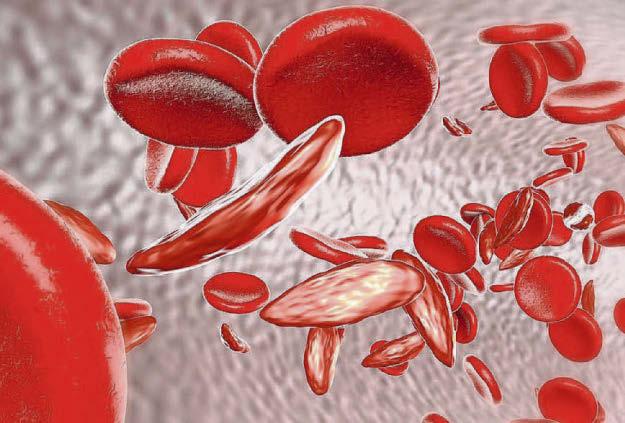 New drug ‘cure’ hope for sickle cell Scots