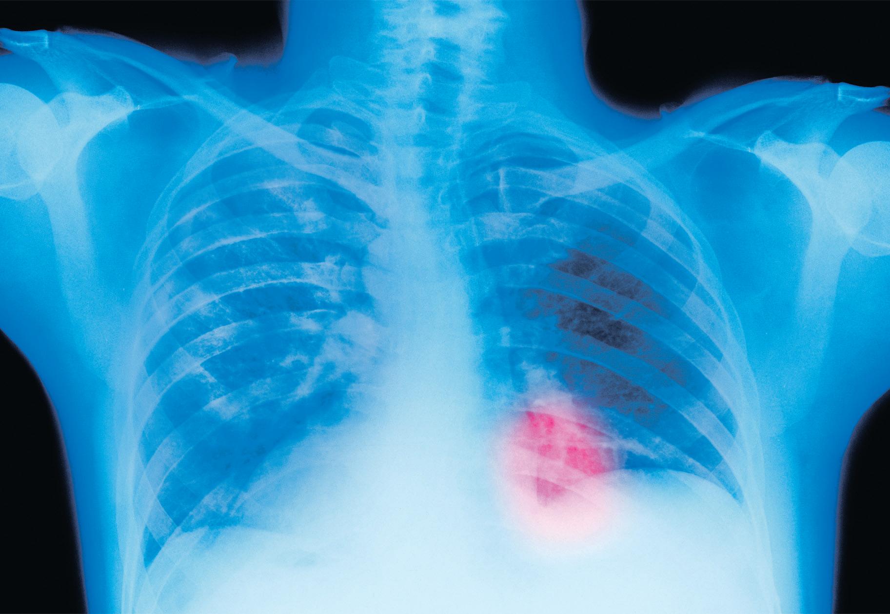 NHS could start offering breast cancer examinations to women in their 30s