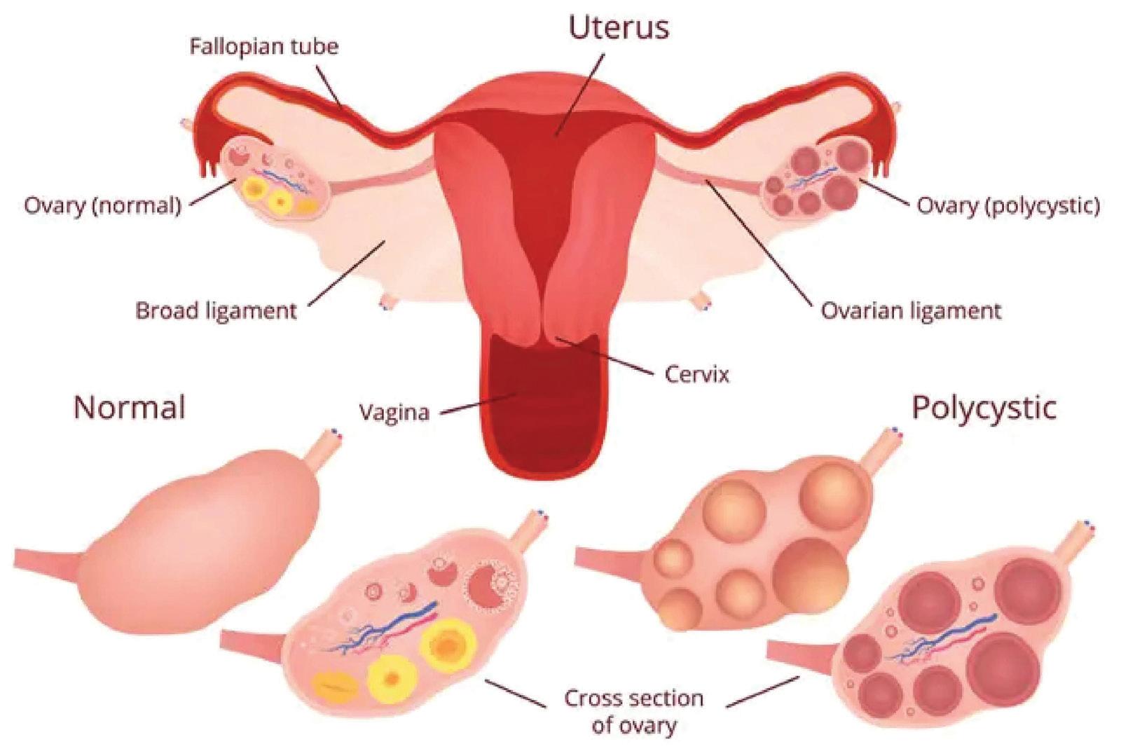 Distinguishing Between Fibroids and Endometriosis: A Clinical Overview