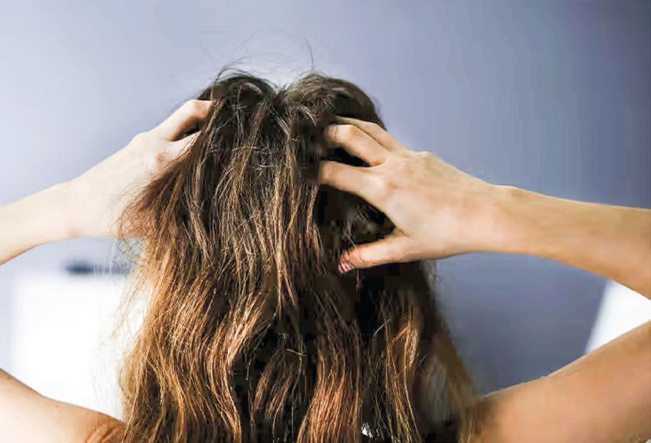 Hair fall is no longer a headache - A new non-surgical super treatment is here