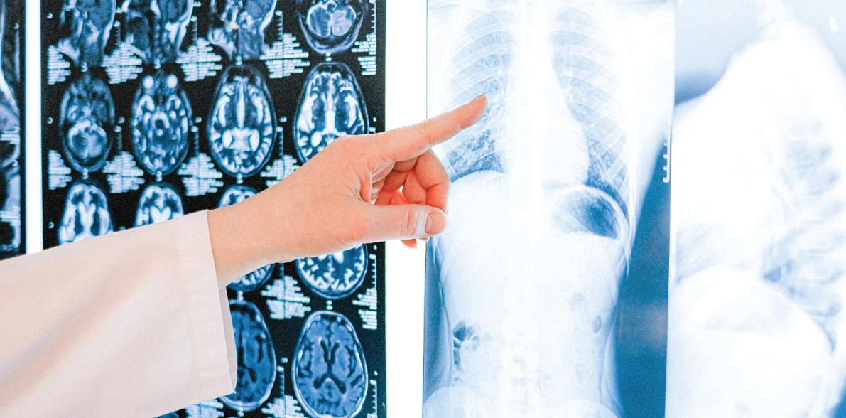 AstraZeneca, Qure.ai Hit 5 Million AI Chest X-Rays for Lung Cancer Detection
