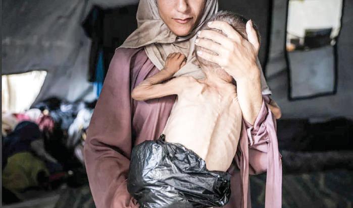 21 Children in Gaza Die of Malnutrition in 72 Hours