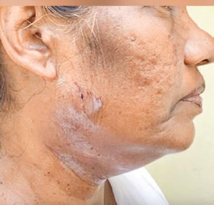 Booth Level Officer suffers injuries after Kottayam local sets dog on her