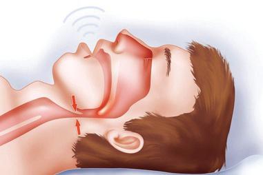 Sleep Apnea: Recognizing the silence, and finding rest