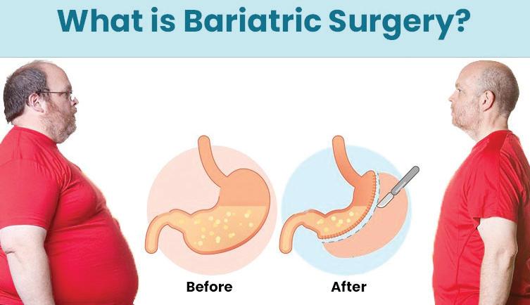 LOOK BEYOND WEIGHT LOSS: THE REAL PURPOSE OF BARIATRIC SURGERY