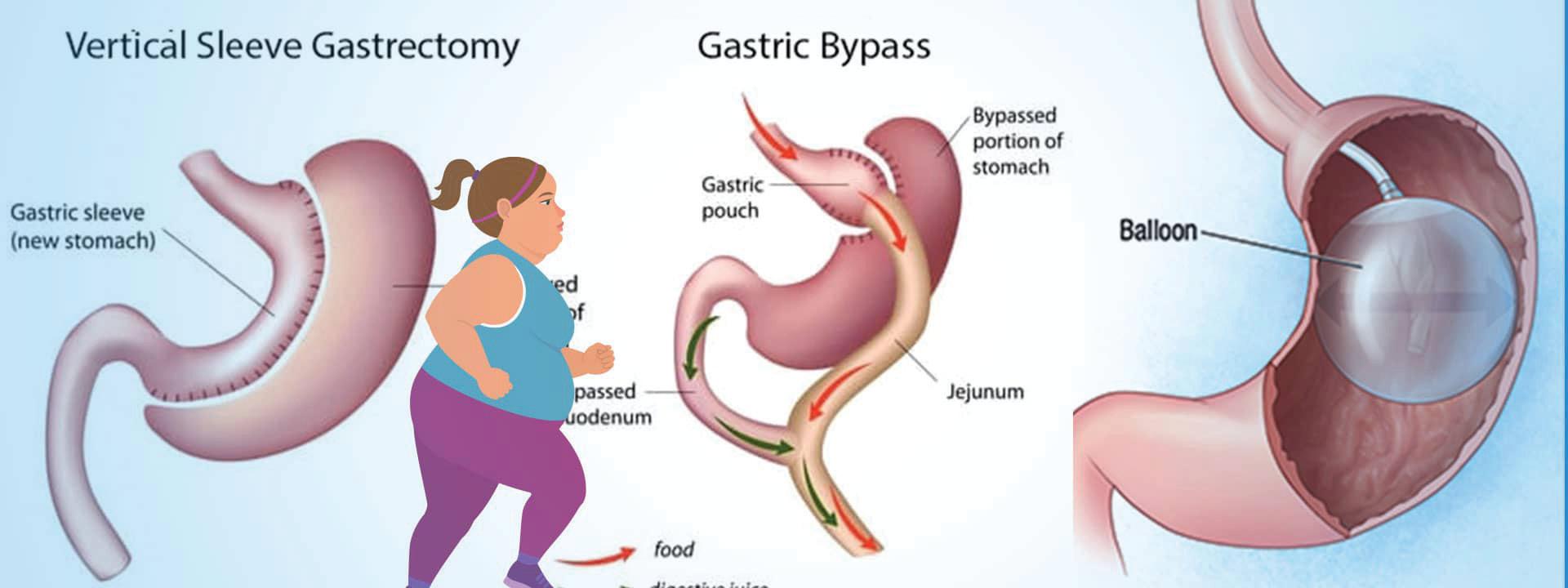The Silent Surgical Risk: Understanding Visceral Fat and the Role of Bariatric Surgery