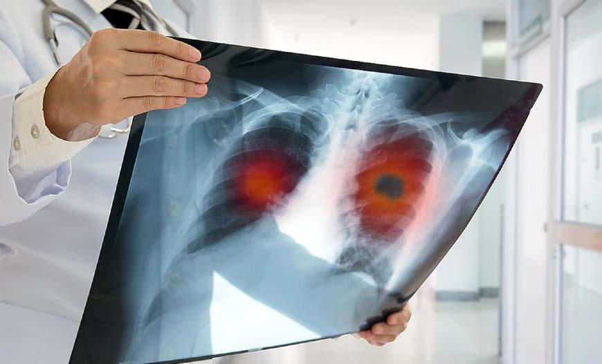 Lung cancer screening is still a decade away