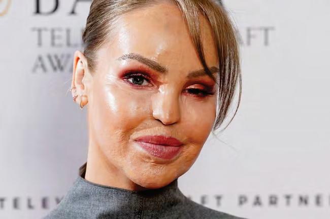 Piper opts for artificial eye 16 years after acid attack