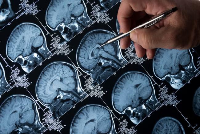 A simple blood test could predict Alzheimer's decline