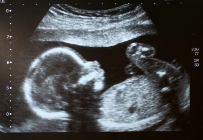 Radiographers sound alarm over high street baby scans