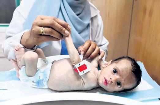 On Gaza malnutrition ward, a child’s arm as wide as mother’s thumb